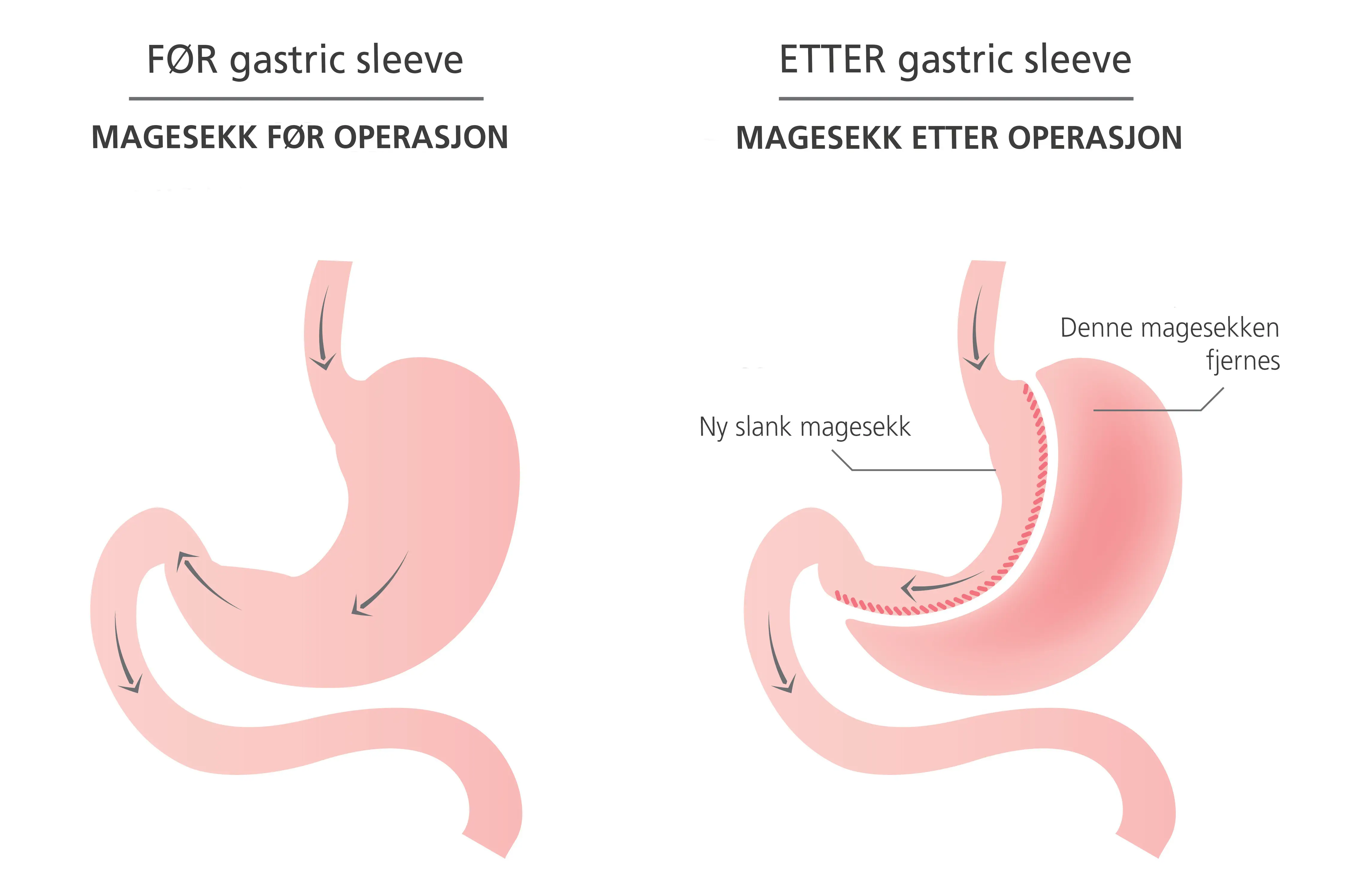 Illustrasjonsbilde av magesekk før og etter operasjon