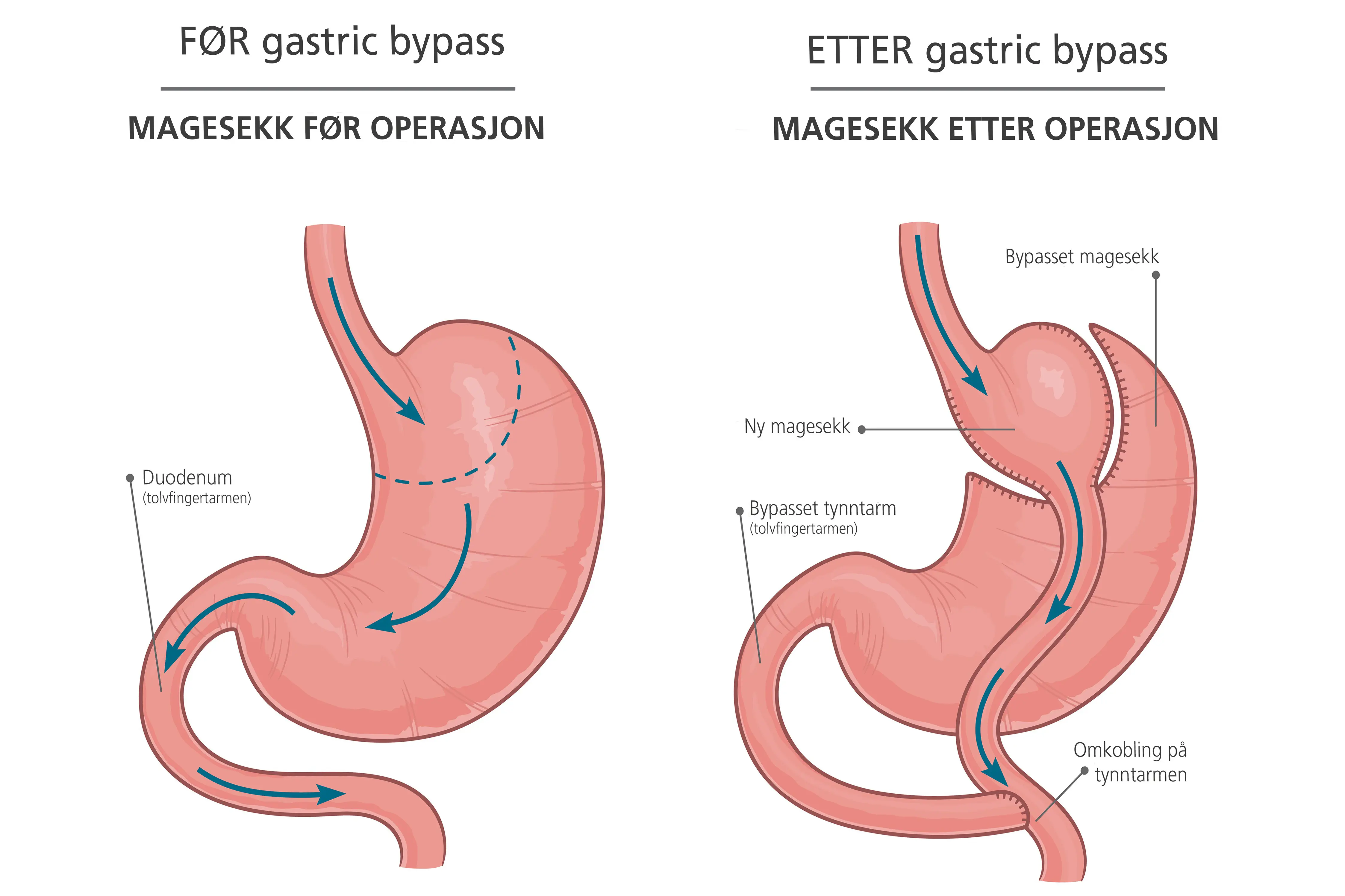 Illustrasjon av magesekk før og etter operasjon
